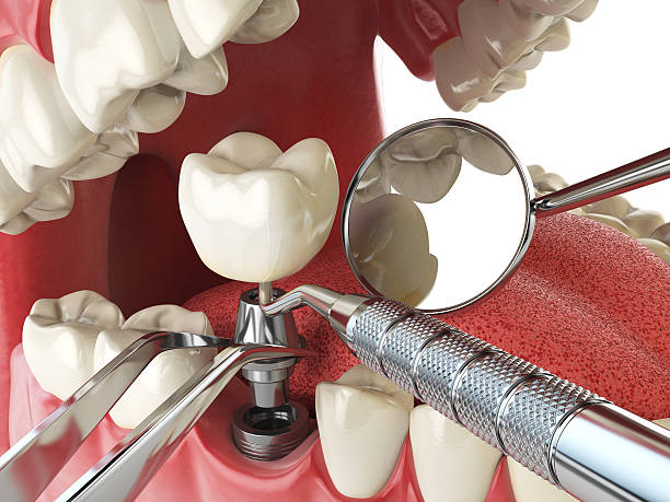 Best Emergency Root Canal Treatment in Butler, OH
